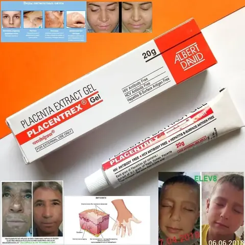 Vitiligo (oq dog‘lar) uchun krem — dengiz iloni ekstraktli